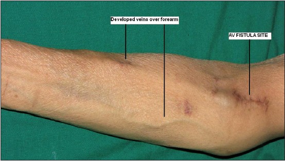 αρτηριοφλεβικη επικοινωνία