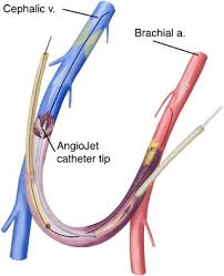 Το συνθετικό μόσχευμα