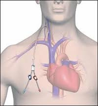 καθετήρες αιμοκάθαρσης